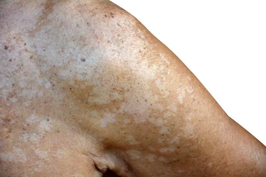 Pityriasis versicolor am Arm